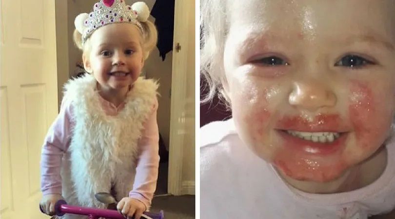 Podczas imprezy urodzinowej twarz dziewczynki zaczęły pokrywać pęcherze