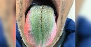 Jego język stał się zielony i włochaty. 64-latek cierpiał od 2 tygodni