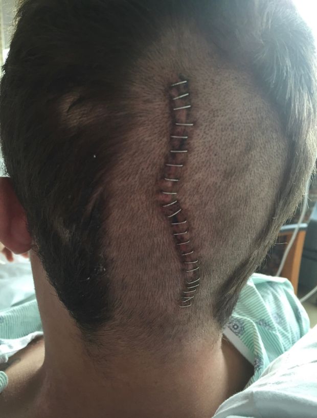 Sam przeszedł trzy operacje mózgu, by usunąć skrzep