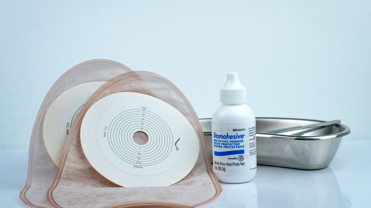 Ureterocutaneostomia to rodzaj urostomii, czyli operacji przeprowadzanej u osób z problemami z wydalaniem moczu