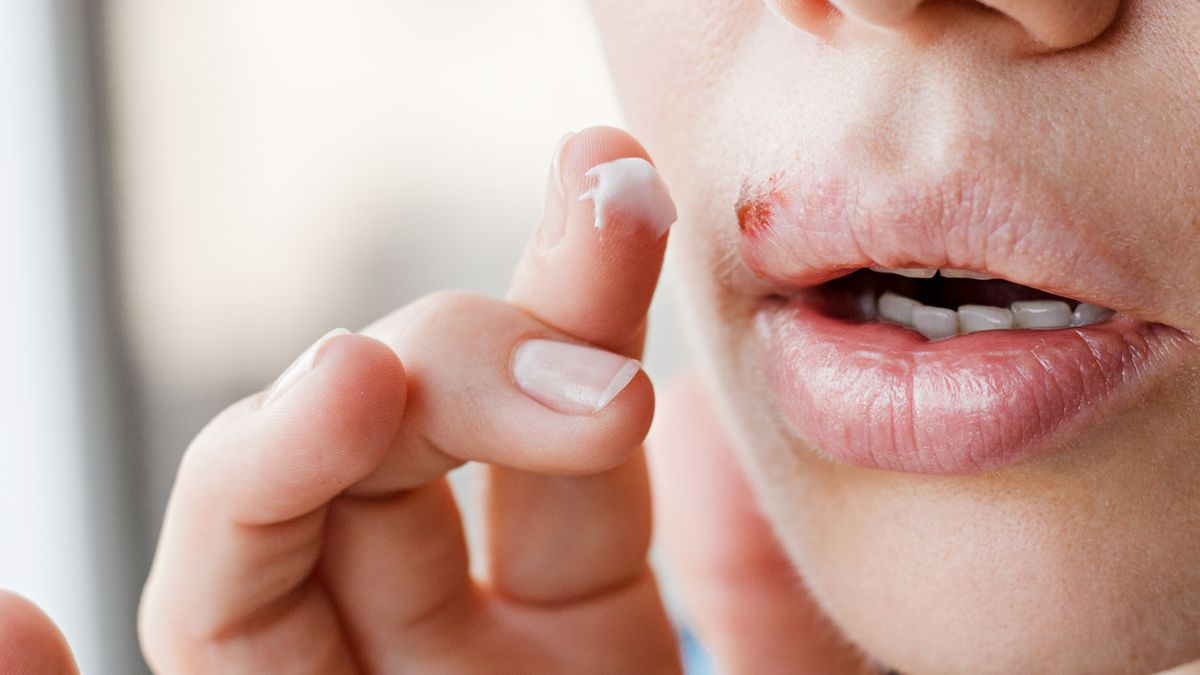 Opryszczka wargowa zazwyczaj zaczyna powoli ustępować w ciągu kilku dni.