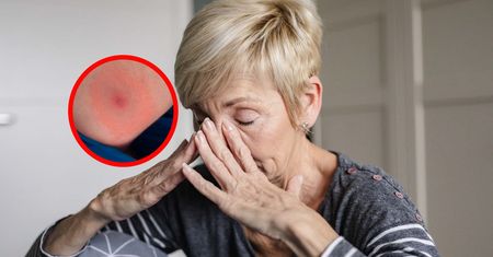 Gwałtowny wzrost przypadków boreliozy i KZM. Lekarze wskazują przyczyny