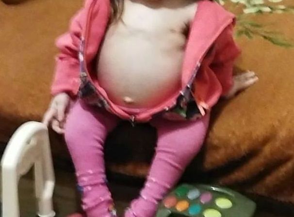 Dziewczynka z opuchniętym brzuchem