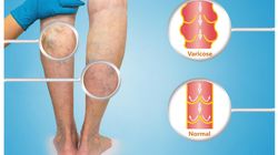 Warfarin - charakterystyka, działanie, skutki uboczne