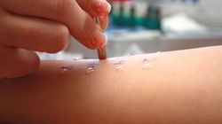 Uczulenie na nikiel - objawy, profilaktyka