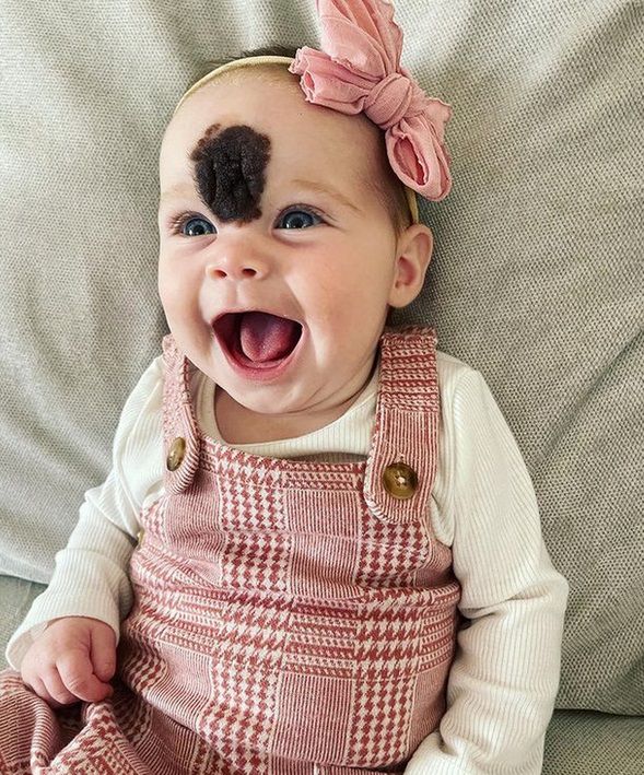 Rodzice bai się, że znamię wpłynie na jej samoocenę