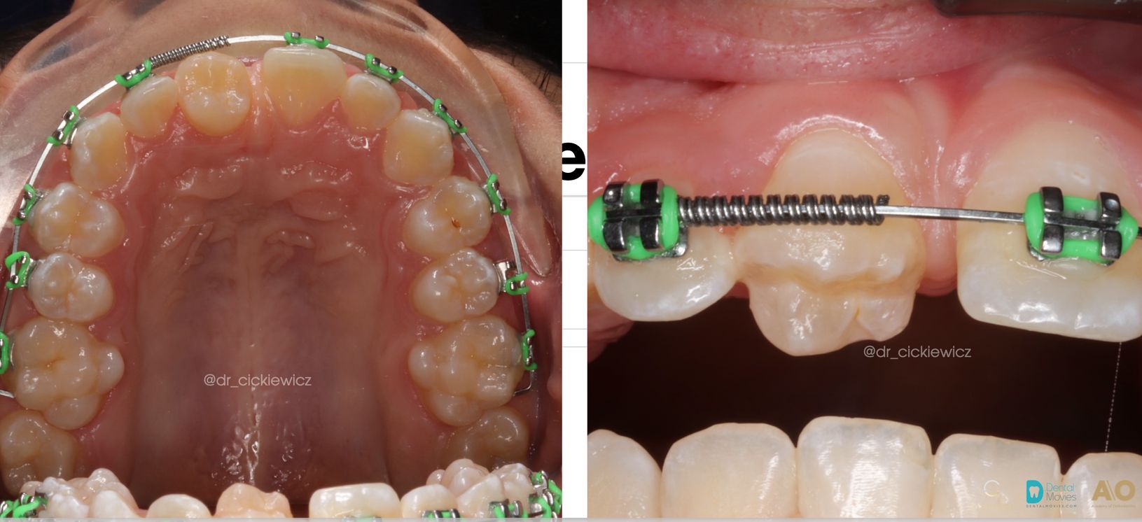 Autotransplantacja dolnej piątki w miejsce górnej jedynki