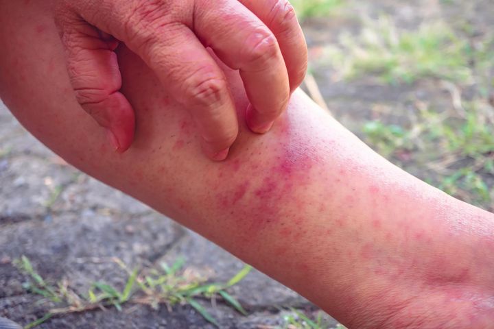 Ukąszenia meszek mogą być szczególnie dotkliwe dla alergików