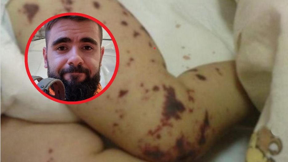 Lekarz nie zauważył wybroczyn na ciele chłopca