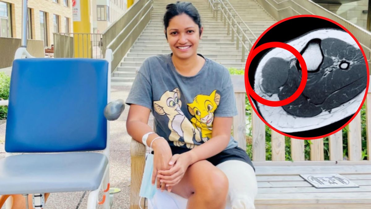 Po amputacji czeka ją jeszcze długie leczenie