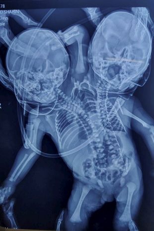 Badanie RTG noworodka