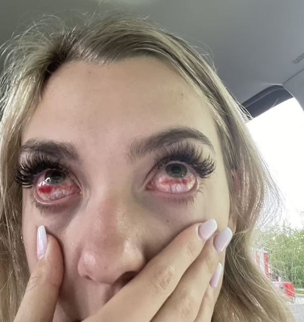 Po zabiegu oczy były silnie przekrwione