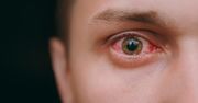 Pęknięte naczynko w oku – popularne przyczyny, zwiastun choroby, u ciężarnych