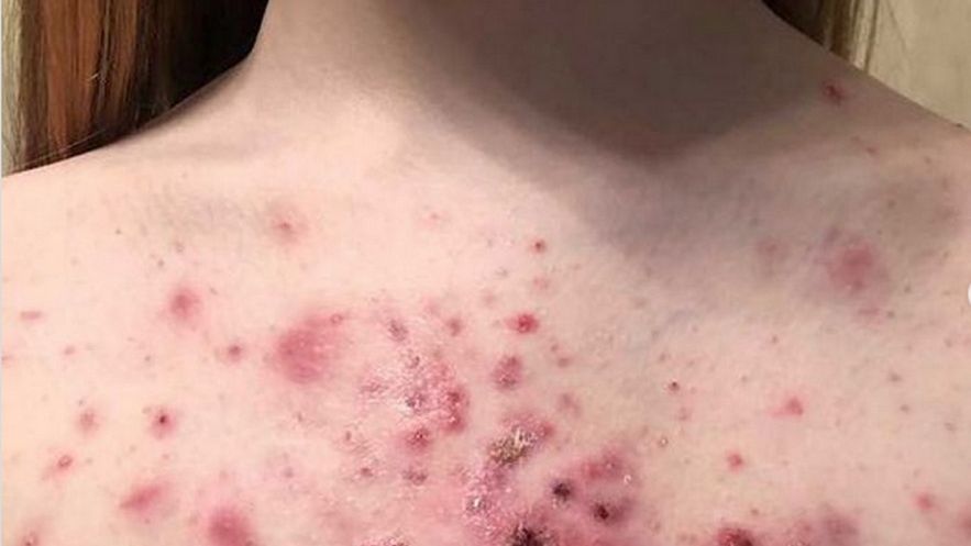 Jednym z objawów COVID-19 jest wysypka na ciele