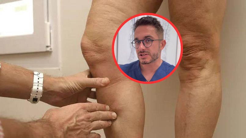 Flebolog ostrzega. "Z problemem boryka się ponad połowa populacji Polski"