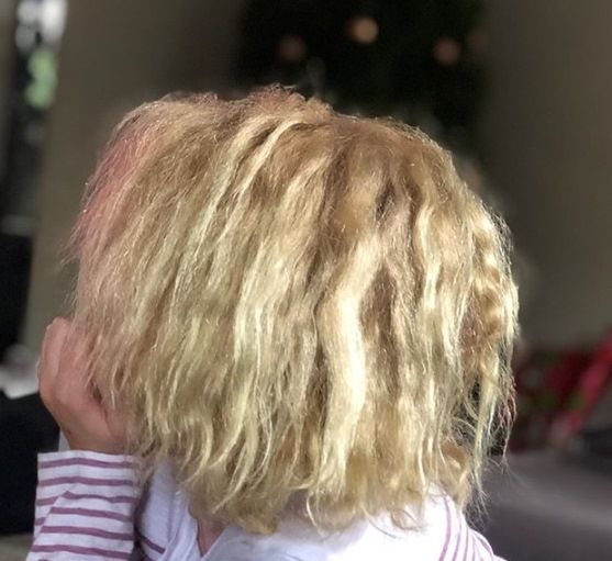 Dziewczynka ma anomalie w strukturze włosa