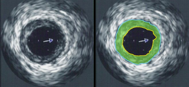 Obraz ultrasonografii wewnątrzwieńcowej