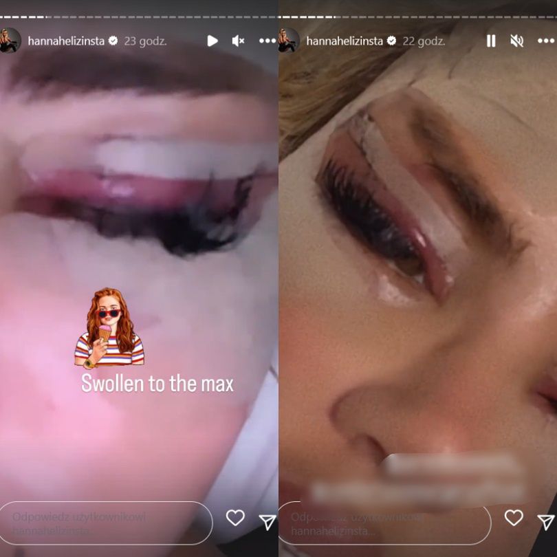 Uczestniczka brytyjskiego "Love Island" chwali się efektami operacji w tureckiej klinice