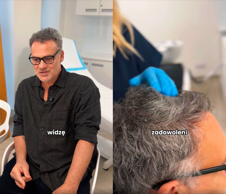 Jan Wieczorkowski przeszedł przeszczep włosów