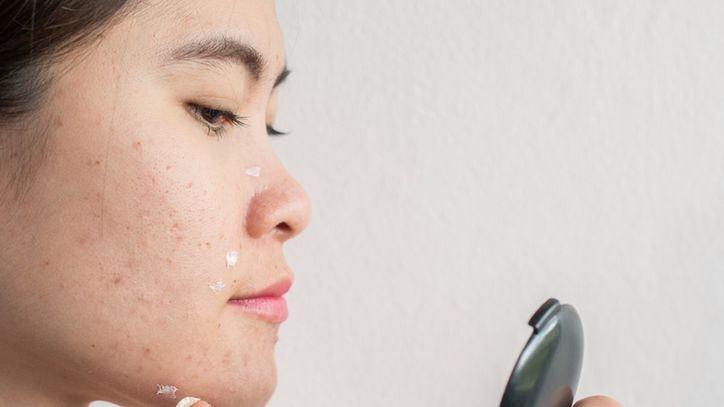 Acne-Derm to krem do cery trądzikowej.