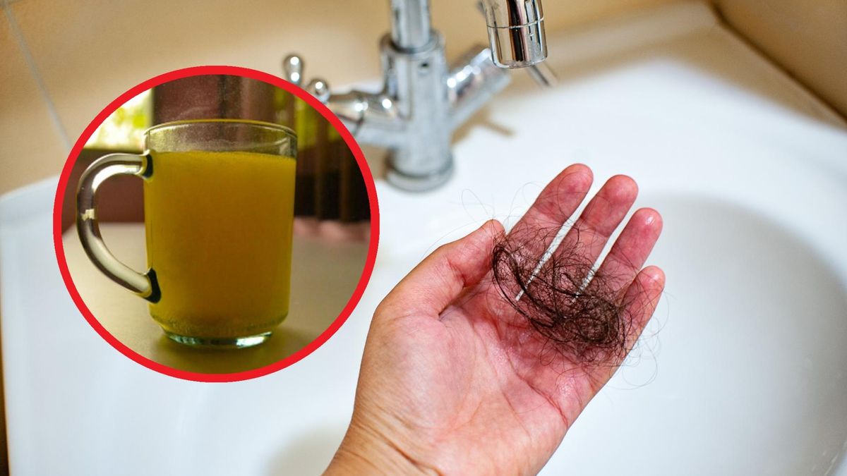 Naukowcy odkryli, że nadużywanie słodkich napojów zwiększa ryzyko łysienia