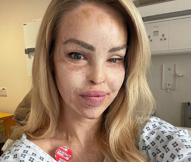 Tak wygląda teraz Katie Piper, która 13 lat temu została oblana kwasem 