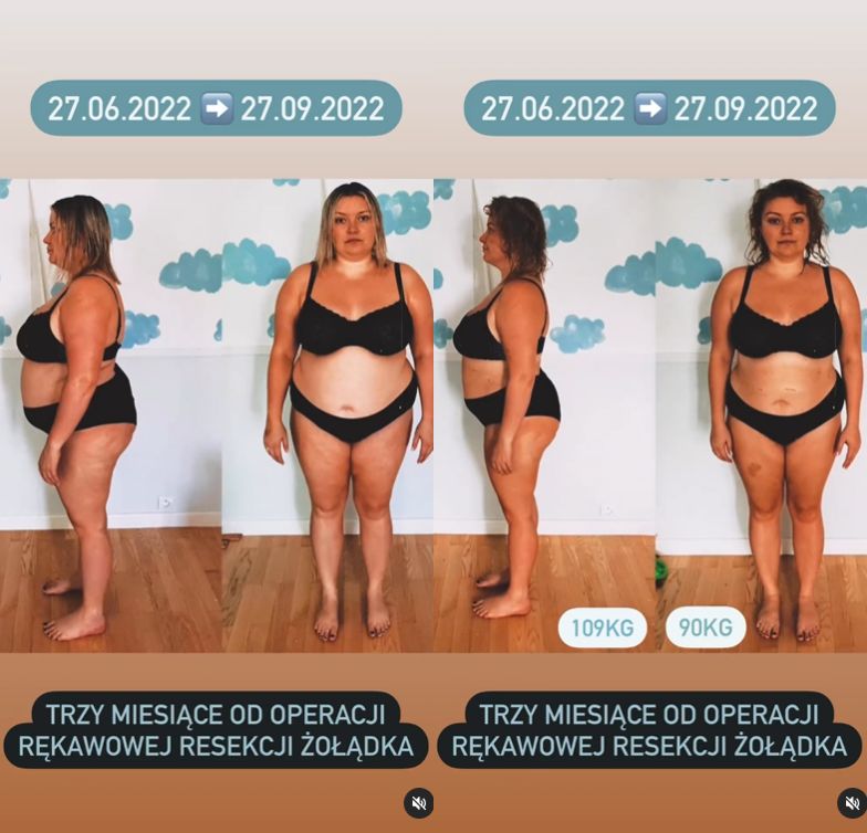 Justyna Mazur pokazuje efekty operacji zmniejszenia żołądka