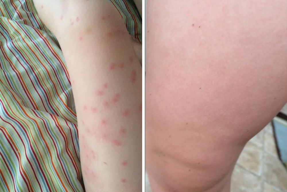 Ślady po kleszczach