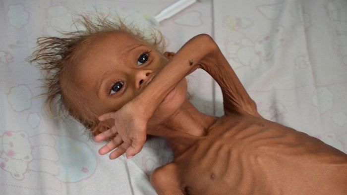 Wojna w Jemenie zbiera duże żniwo, przede wszystkim jest to koszmar dzieci