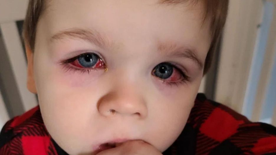 Zakażenie oka wywołane pleśnią