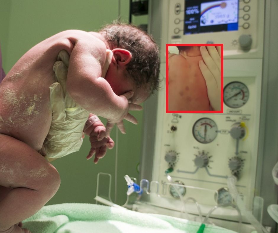 Położna zauważyła fioletowe kropki. To był jedyny objaw groźnej choroby