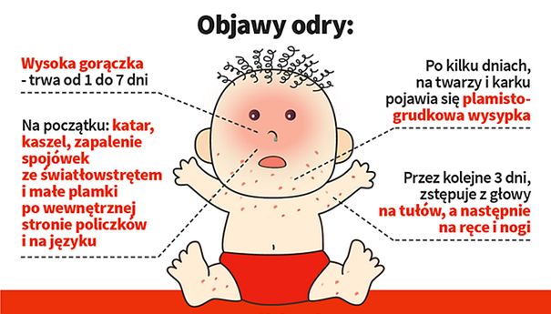 Objawy odry u dziecka