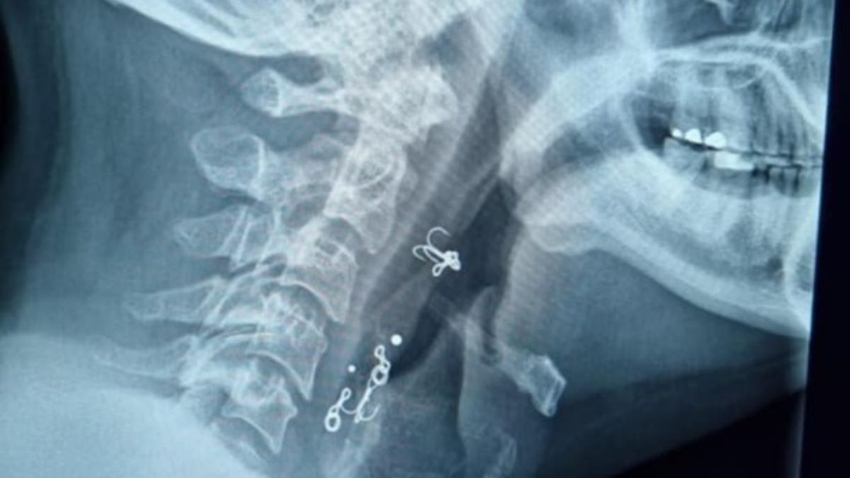 Lekarz dokonał szokującego odkrycia na zdjęciu rentgenowskim 