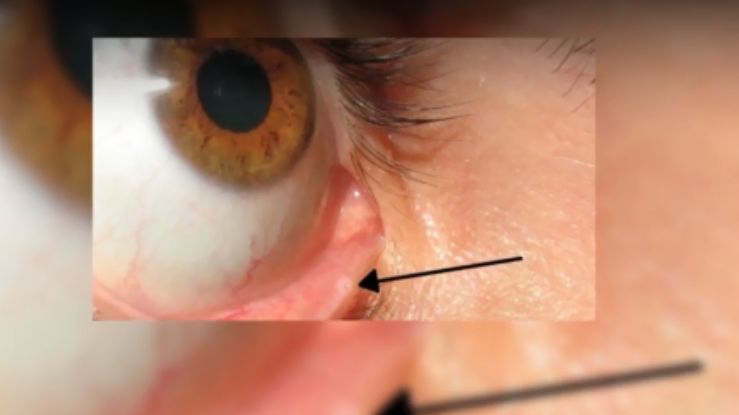 Większość z nas nie zdaje sobie sprawy z posiadania dziurki na dolnej powiece 