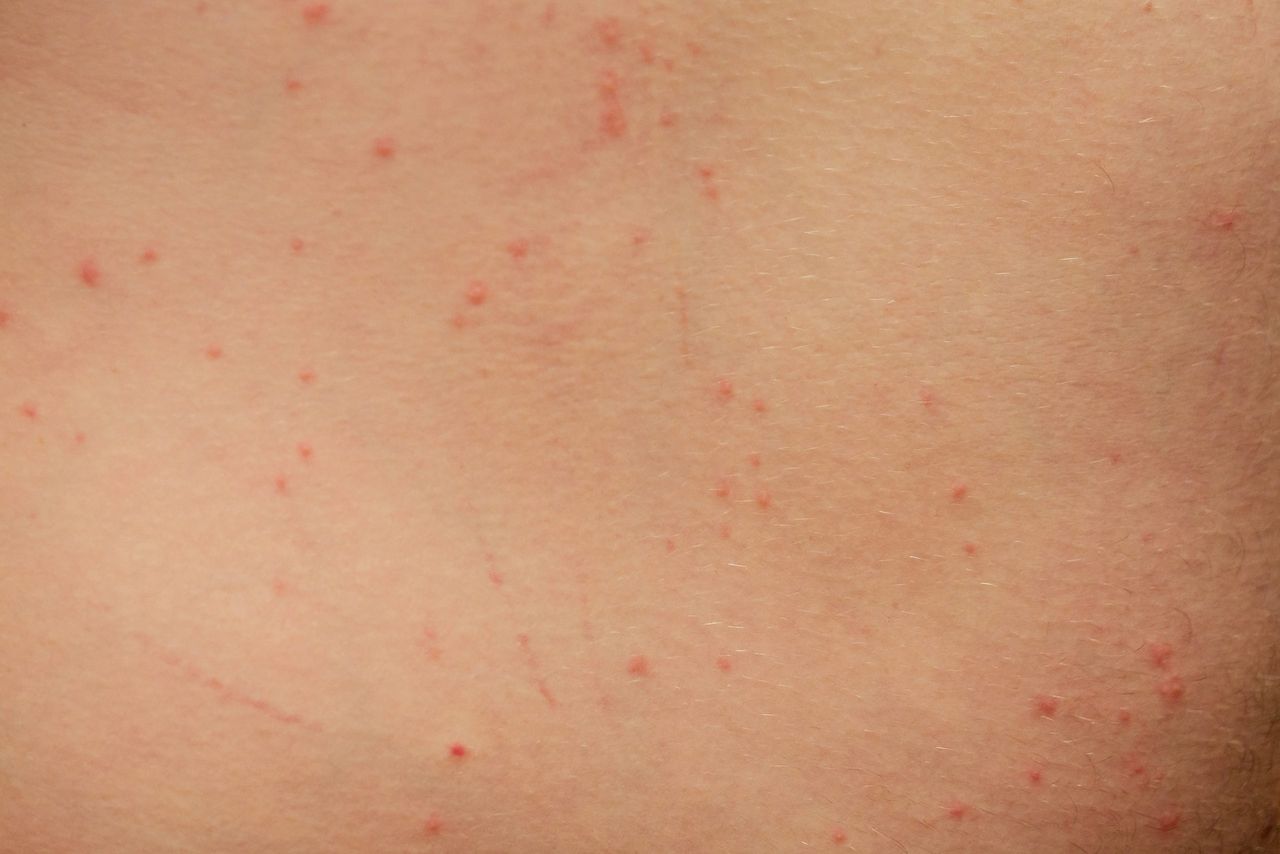 Woman with itching from biting insect in body in tropical jungle forest.