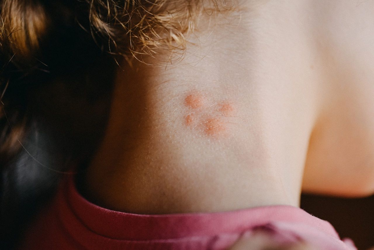 Insect bites on child's neck. Close up.