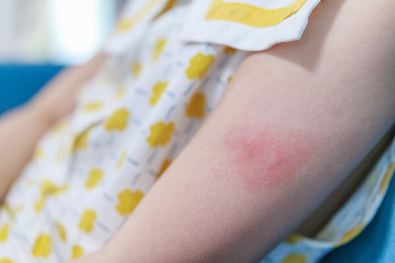 Little girl has skin rash allergy itching and scratching on her arm