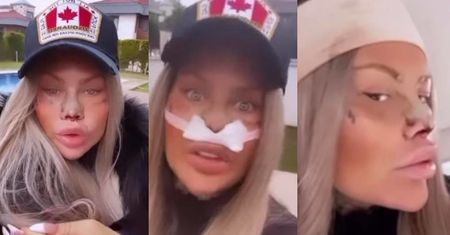 Laluna Unique z "Królowych Życia" skwapliwie dokumentuje schodzącą opuchliznę: "Żyję jak J***NA BARBIE"