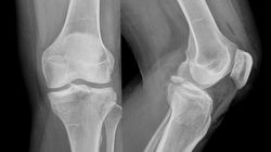 Złamanie awulsyjne - przyczyny, objawy i leczenie