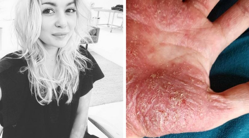 13-latka straciła ojca i wpadła w depresję. Na jej ciele zaczęły pojawiać się dziwne plamy