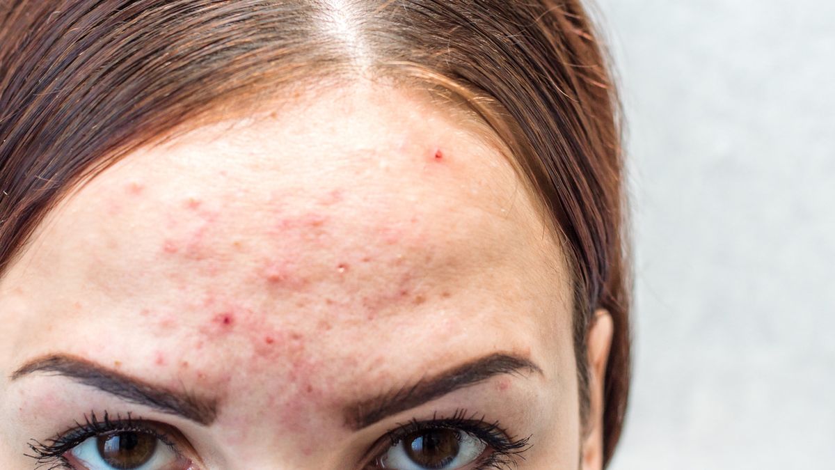 Trądzik pospolity występuje najczęściej u młodzieży w okresie pokwitania tj. między 13. a 20. rokiem życia.