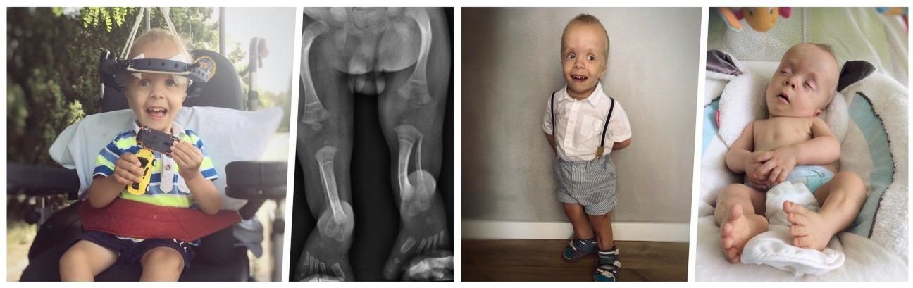 Rodzicom Adasia sugerowano aborcję. Dziś chłopiec ma 5 lat i potrzebuje operacji nóg 