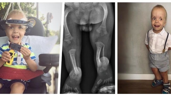 Rodzicom Adasia sugerowano aborcję. Dziś chłopiec ma 5 lat i potrzebuje operacji nóg 