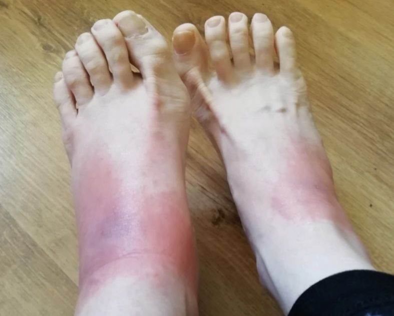 Wysypka pojawia się na różnych częściach ciała