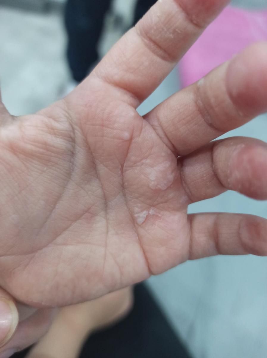 Po przejściu choroby dziewczynce schodziła skóra z całego ciała