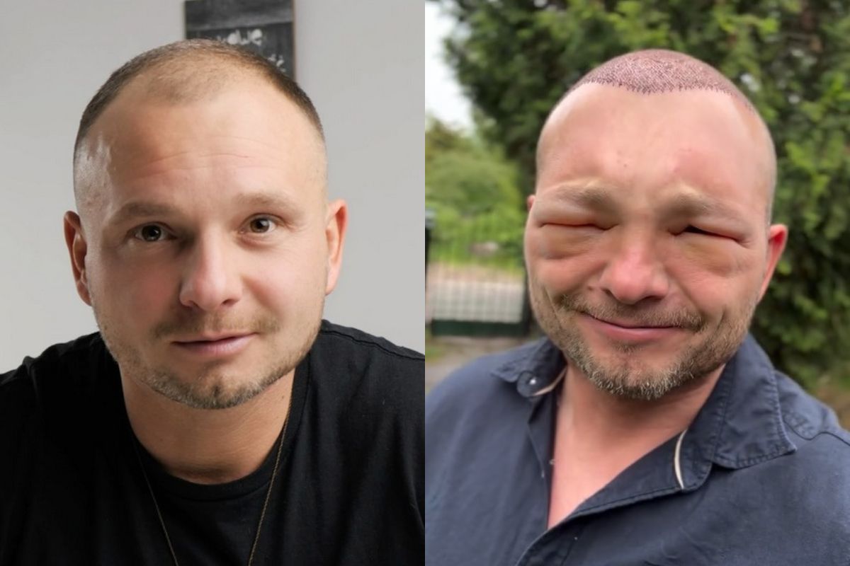 Influencer pokazał skutki uboczne przeszczepu włosów