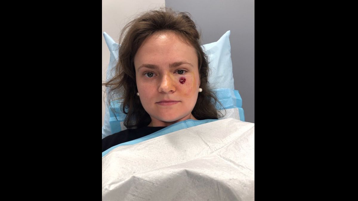 "Pryszcz" okazał się być groźnym nowotworem skóry