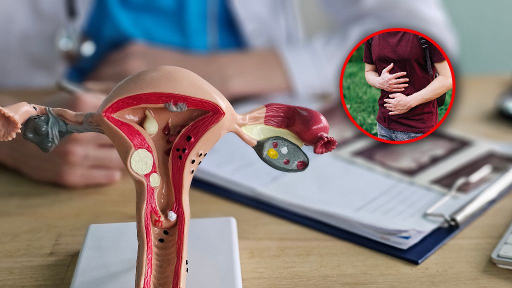 Rak jajnika i jelita grubego