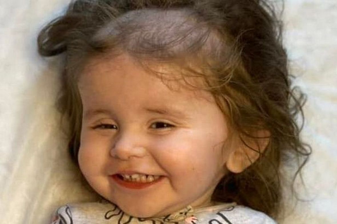 Dwuletnia dziewczynka, z powodu choroby, wyrywała sobie włosy z głowy