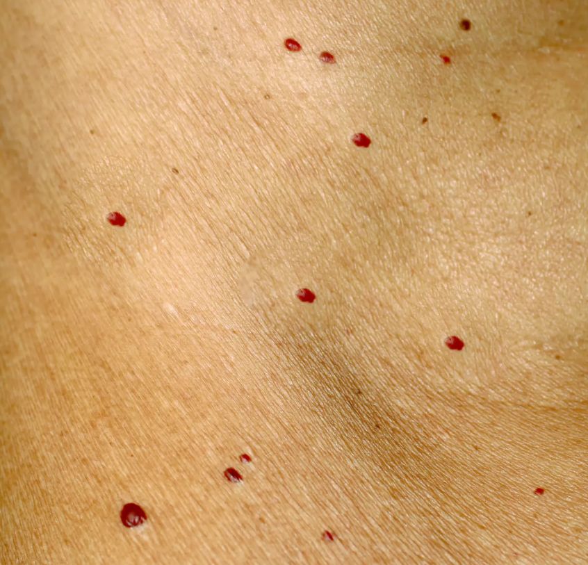 "Rubinki" mogą być oznaką problemów ze zdrowiem